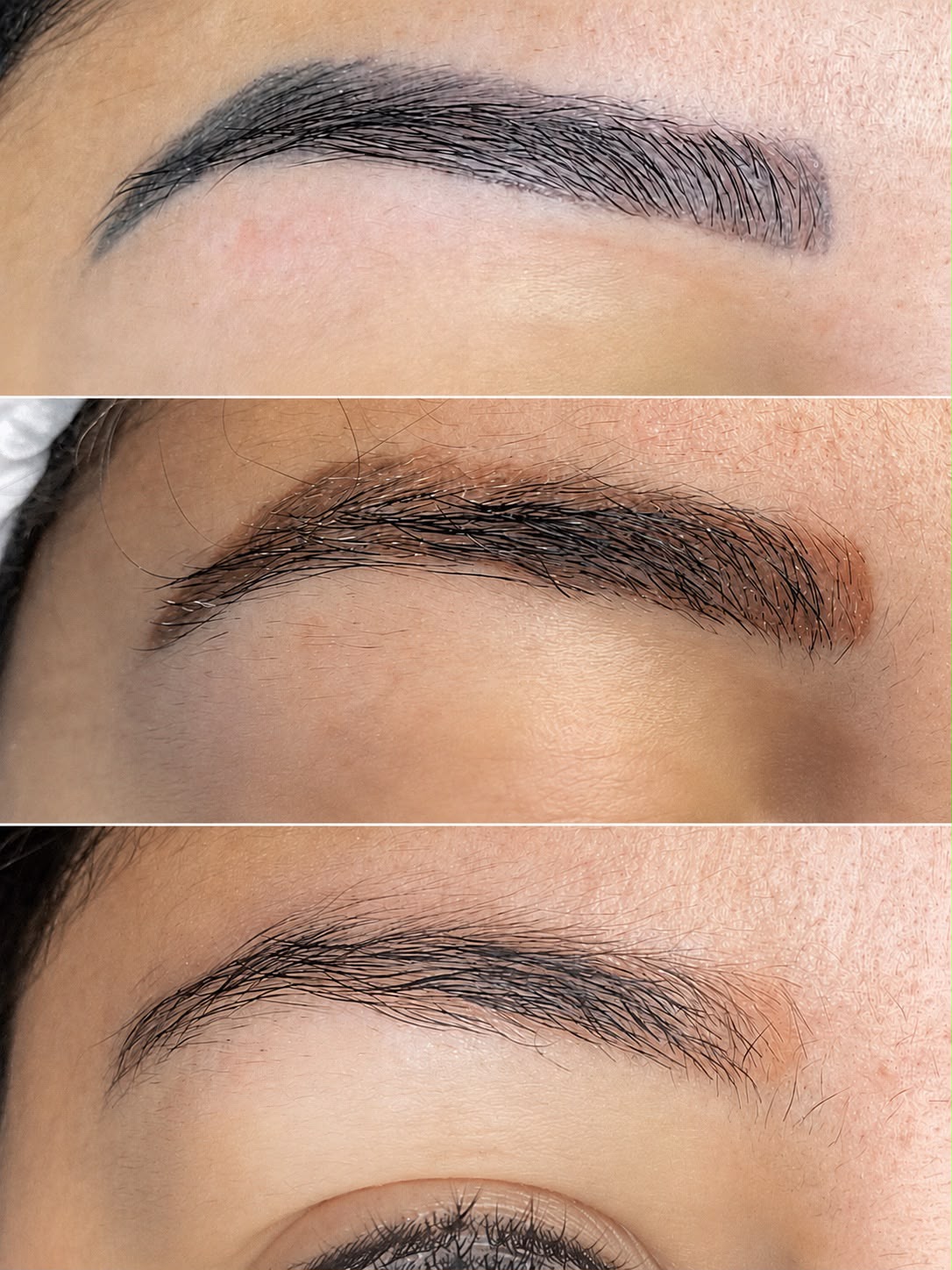 Remoção a Laser — Sessões de remoção clareando uma micro antiga.